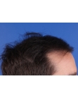 Before Hair Transplant&nbsp;Hairlines